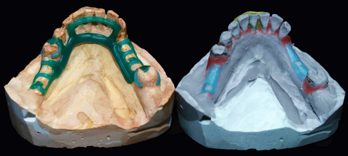 revolutionizing-rehabilitation-prosthodontic-management-of-distal